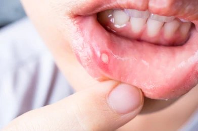 Mouth Sores: A Red Flag for Your Gastrointestinal Health