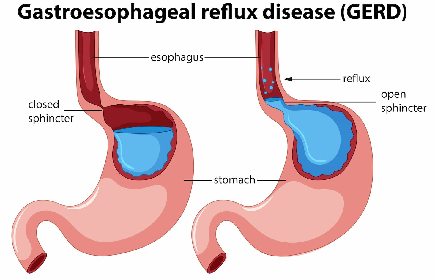 6 GERD Signs You Should Not Ignore